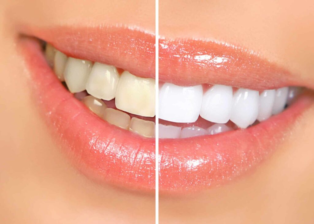 Teeth Whitening Salon